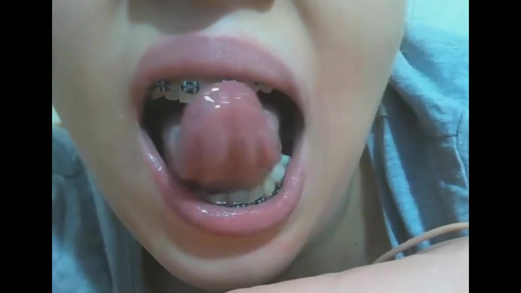 Mouth fetish braces